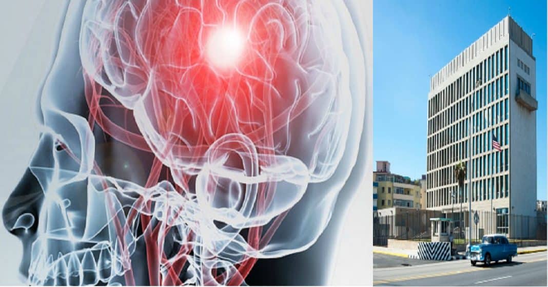 síndrome de la habana