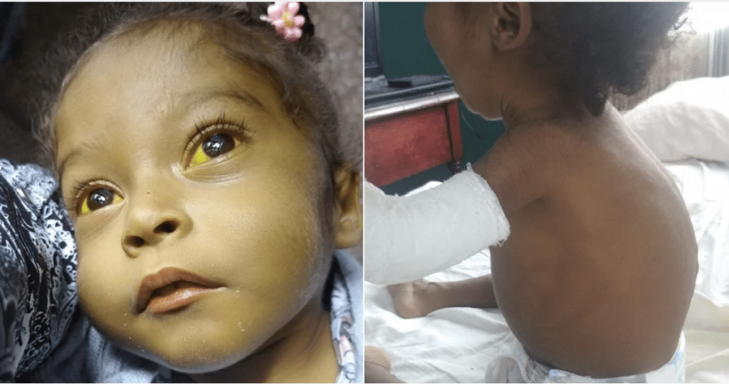 La niña Amanda Lemus Ortiz no puede ser operada en un país que continúa exportando personal de salud.