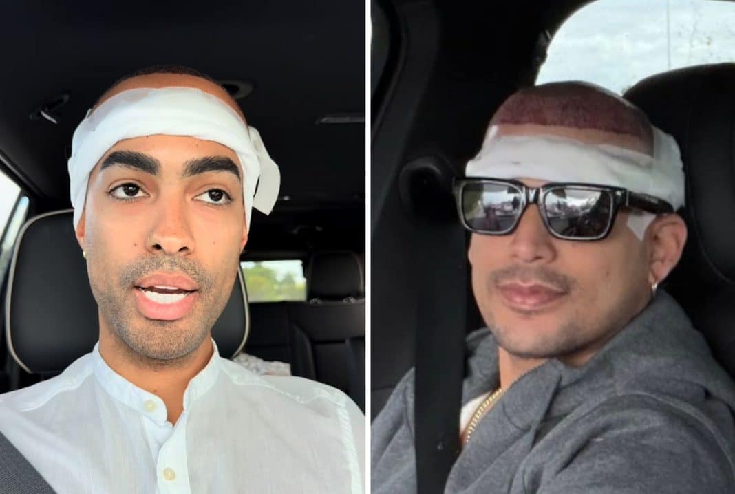 Pollito Tropical y Ultrack se suman al boom de trasplantes capilares en Miami