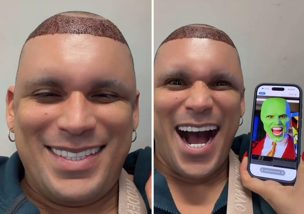 Así luce el rostro de Ultrack al tercer día de su cirugía capilar: “Me parezco al de La Máscara”