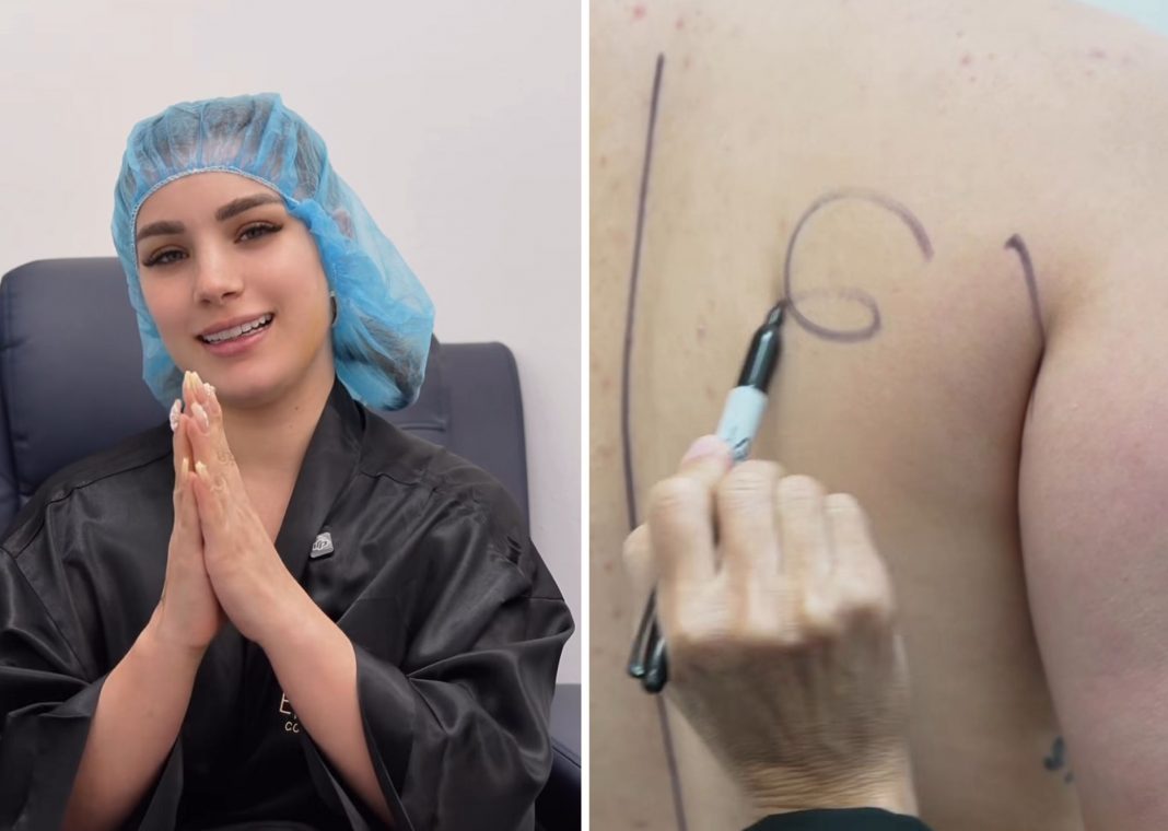 Lipo en los brazos y un mini tummy tuck: Claudia Artiles revela todo lo que se hizo en su cirugía plástica